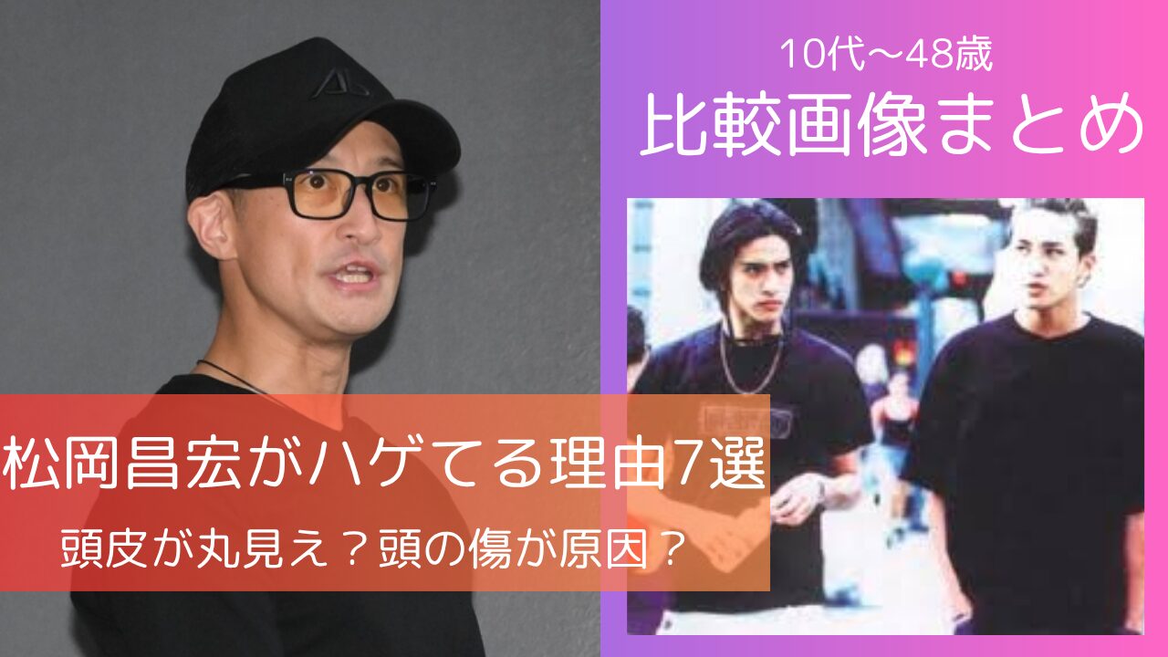松岡昌宏がハゲてると言われる理由と比較画像があることを伝えてます。